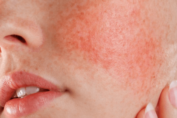 Khăn ướt có cồn gây kích ứng, đỏ rát và viêm da
