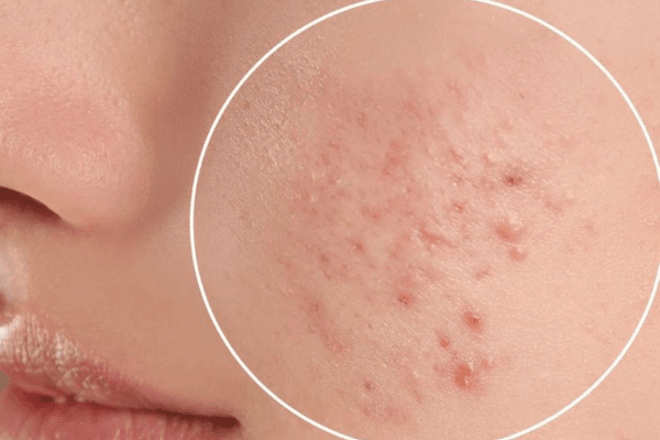 Khăn ướt có cồn gây tình trạng mụn