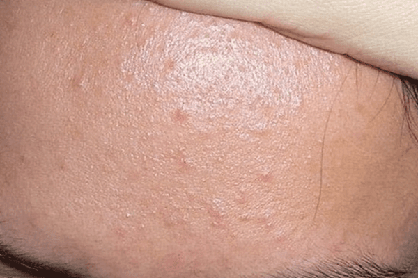 Phân biệt mụn ẩn với các loại mụn khác