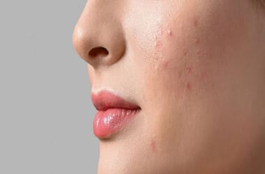 Nguyên Nhân Gây Mụn Ẩn Và Cách Ngăn Ngừa Mụn Hiệu Quả
